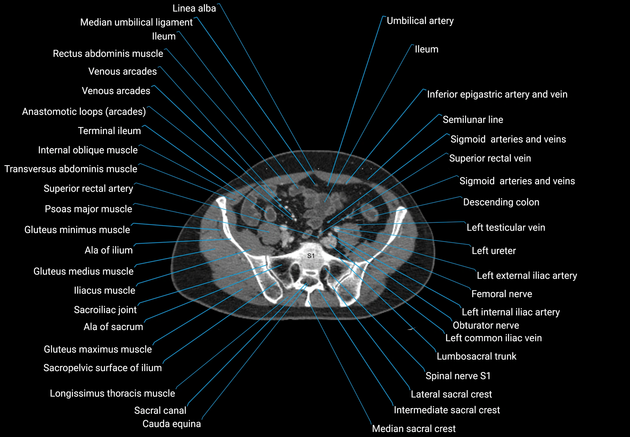 CT male pelvis axial cross sectional anatomy labelled radiology image -00144.webp